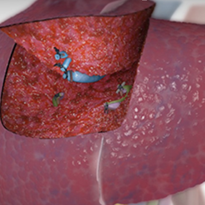 Minimally Invasive Hepatic Treatment